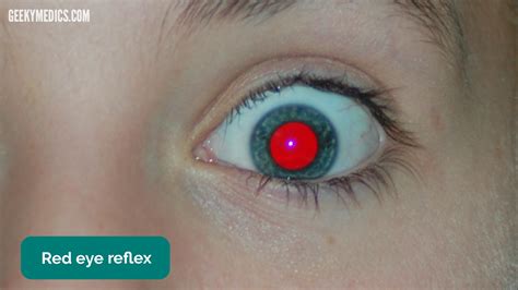 fundoscopy findings|fundoscopy findings geeky medics.